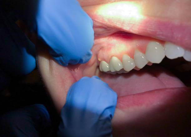 Best Emergency Dentist for Lost Fillings or Crowns in Palmer, TX